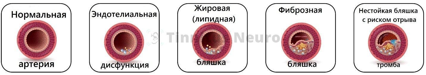 Стадии атеросклероза